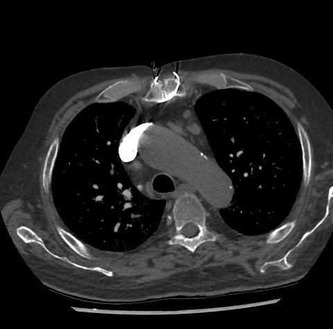 Chronic thromboembolic pulmonary disease (Radiopaedia 90694-108119 Axial C+ CTPA 30).jpg