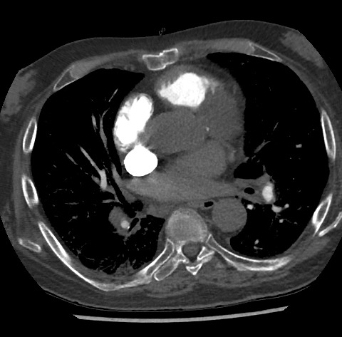 Chronic thromboembolic pulmonary disease (Radiopaedia 90694-108119 Axial C+ CTPA 55).jpg