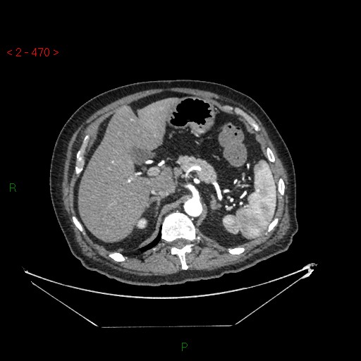 Circumaortic left renal vein and doubled left renal arteries (Radiopaedia 52268-58158 A 6).jpg