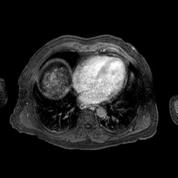 Cirrhosis and hepatocellular carcinoma in the setting of hemochromatosis (Radiopaedia 75394-86594 Axial T1 C+ fat sat 339).jpg