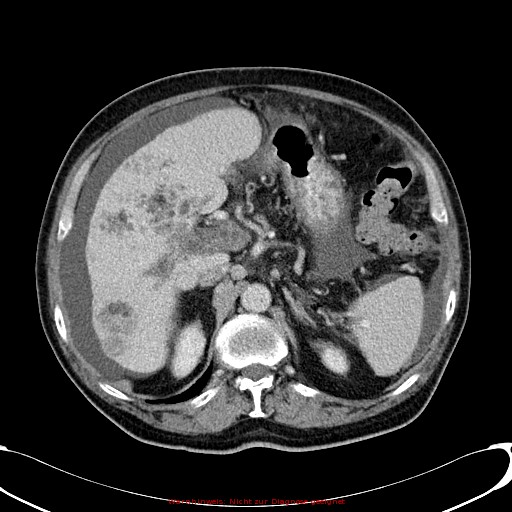 File:Cirrhosis and hepatocellular carcinoma in the setting of hemochromatosis (Radiopaedia 75394-86595 B 30).jpg