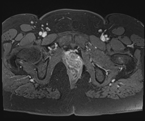 File:Class II Mullerian duct anomaly- unicornuate uterus with rudimentary horn and non-communicating cavity (Radiopaedia 39441-41755 Axial T1 fat sat 123).jpg