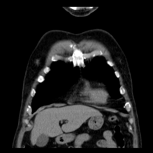 File:Classic complicated silicosis (Radiopaedia 49720-54961 Coronal liver window 6).jpg