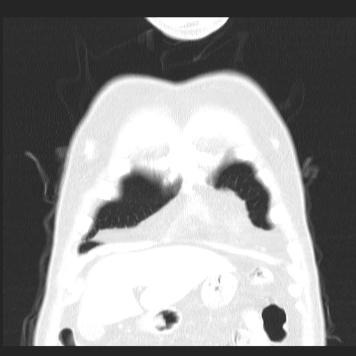 File:Classic complicated silicosis (Radiopaedia 49720-54961 Coronal lung window 3).jpg