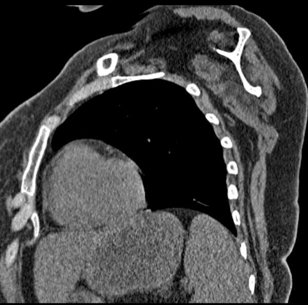 Clear cell chondrosarcoma - humerus (Radiopaedia 63104-71612 D 47).jpg