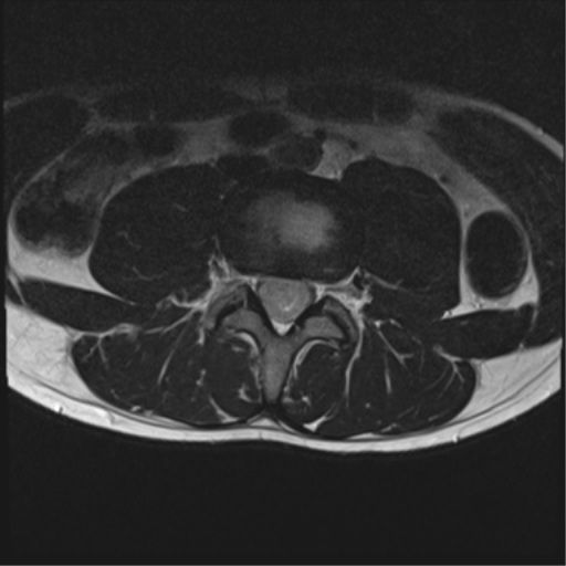 File:Clear cell meningoma - lumbar spine (Radiopaedia 60116-67690 Axial T2 18).png