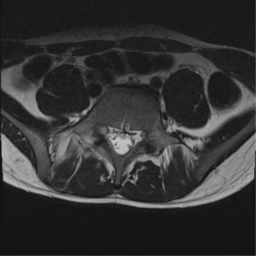 File:Clear cell meningoma - lumbar spine (Radiopaedia 60116-67690 Axial T2 9).png