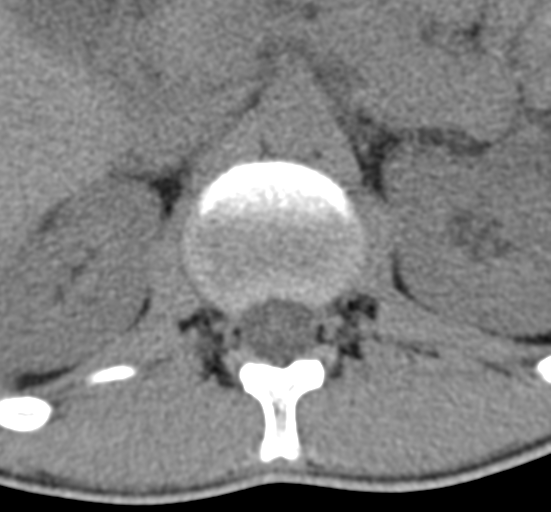 Clear cell meningoma - lumbar spine (Radiopaedia 60116-67691 Axial non-contrast 9).png
