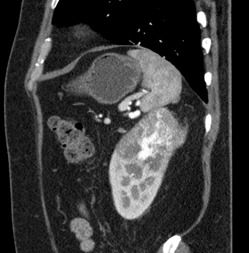File:Clear cell renal cell carcinoma (Radiopaedia 61449-69393 D 15).jpg