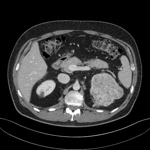 File:Clear cell renal cell carcinoma (Radiopaedia 61449-69393 E 21).jpg