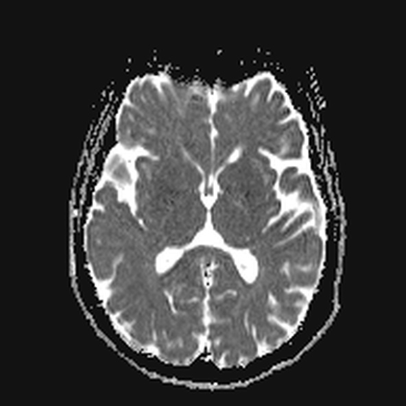 File:Clival meningioma (Radiopaedia 53278-59248 Axial ADC 13).jpg