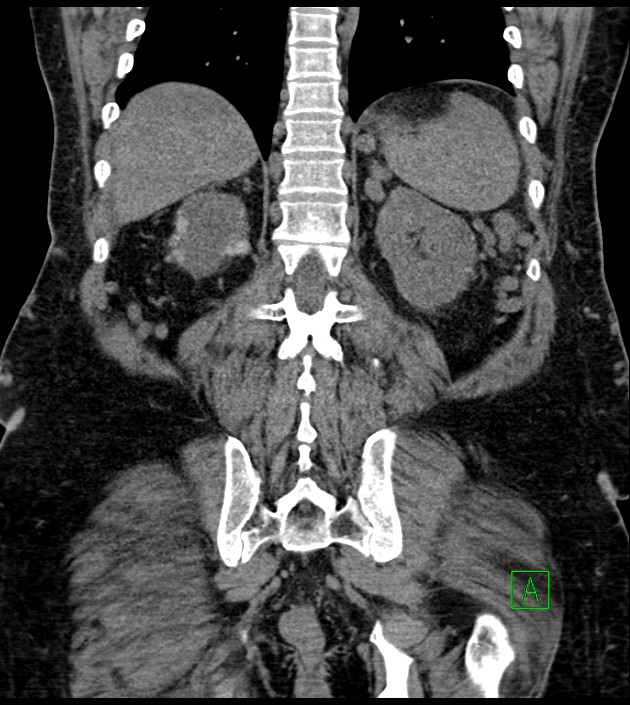 Closed-loop small bowel obstruction-internal hernia (Radiopaedia 78439-91096 Coronal non-contrast 77).jpg