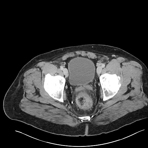 File:Closed loop obstruction - internal hernia into nephrectomy bed (Radiopaedia 59867-67320 A 132).jpg