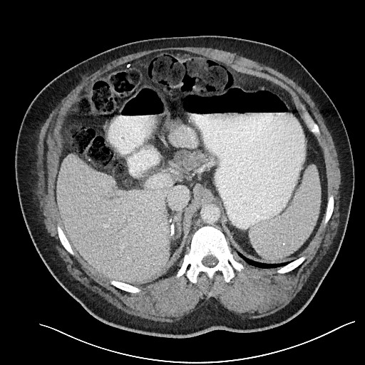 File:Closed loop obstruction - internal hernia into nephrectomy bed (Radiopaedia 59867-67320 A 38).jpg