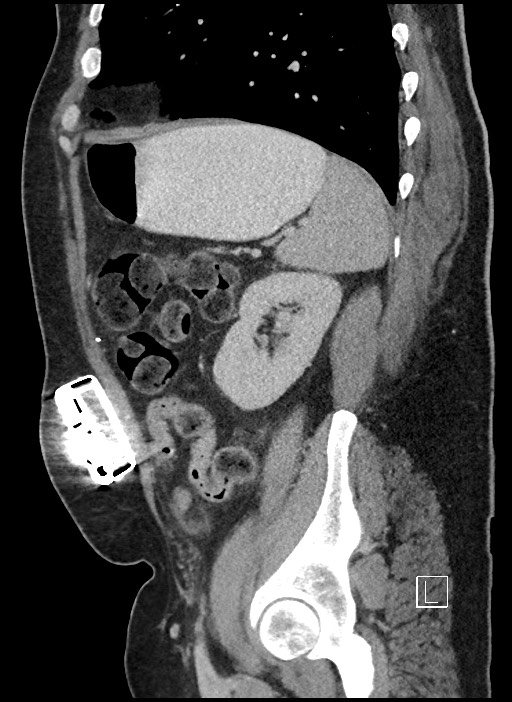 Closed loop obstruction - internal hernia into nephrectomy bed (Radiopaedia 59867-67320 C 18).jpg