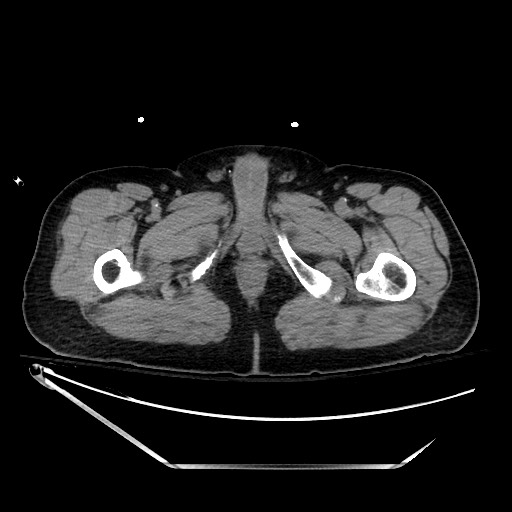 File:Closed loop obstruction due to adhesive band, resulting in small bowel ischemia and resection (Radiopaedia 83835-99023 Axial 140).jpg