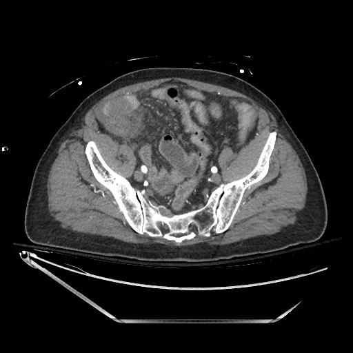 File:Closed loop obstruction due to adhesive band, resulting in small bowel ischemia and resection (Radiopaedia 83835-99023 B 122).jpg