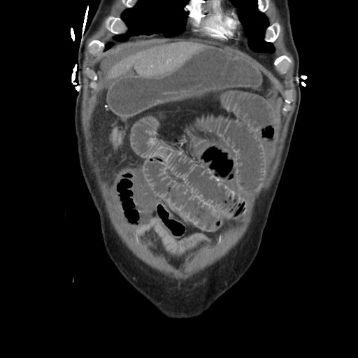 File:Closed loop obstruction due to adhesive band, resulting in small bowel ischemia and resection (Radiopaedia 83835-99023 C 28).jpg