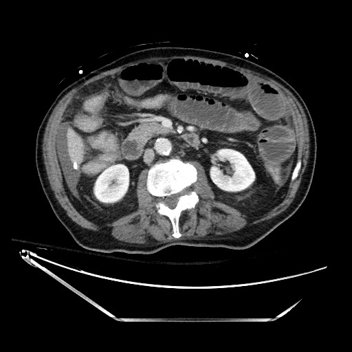 File:Closed loop obstruction due to adhesive band, resulting in small bowel ischemia and resection (Radiopaedia 83835-99023 D 69).jpg