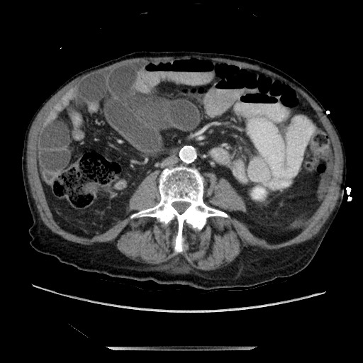 Closed loop small bowel obstruction - adhesive disease and hemorrhagic ischemia (Radiopaedia 86831-102990 A 105).jpg