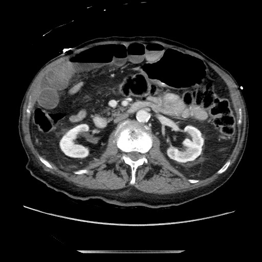 Closed loop small bowel obstruction - adhesive disease and hemorrhagic ischemia (Radiopaedia 86831-102990 A 85).jpg