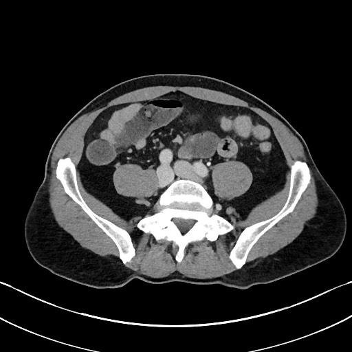 Closed loop small bowel obstruction - internal hernia (Radiopaedia 57806-64778 B 84).jpg