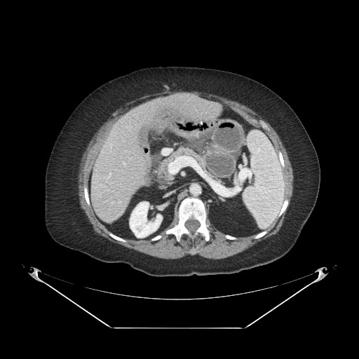 Closed loop small bowel obstruction - internal hernia (Radiopaedia 65402-74450 A 40).jpg