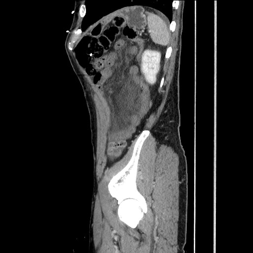 Closed loop small bowel obstruction - omental adhesion causing "internal hernia" (Radiopaedia 85129-100682 C 145).jpg