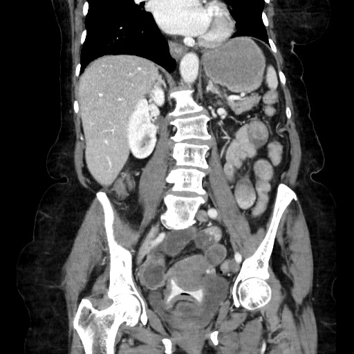Closed loop small bowel obstruction due to adhesive band, with intramural hemorrhage and ischemia (Radiopaedia 83831-99017 C 72).jpg