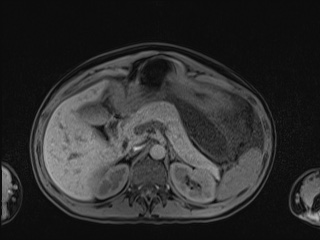 Closed loop small bowel obstruction in pregnancy (MRI) (Radiopaedia 87637-104031 Axial T1 fat sat 37).jpg