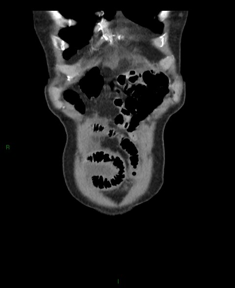 File:Closed loop small bowel obstruction with ischemia (Radiopaedia 84180-99456 B 61).jpg