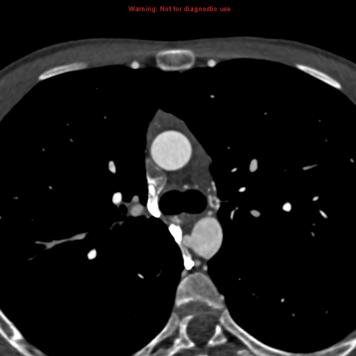 File:Coarctation of the aorta (Radiopaedia 12461-12697 A 136).jpg