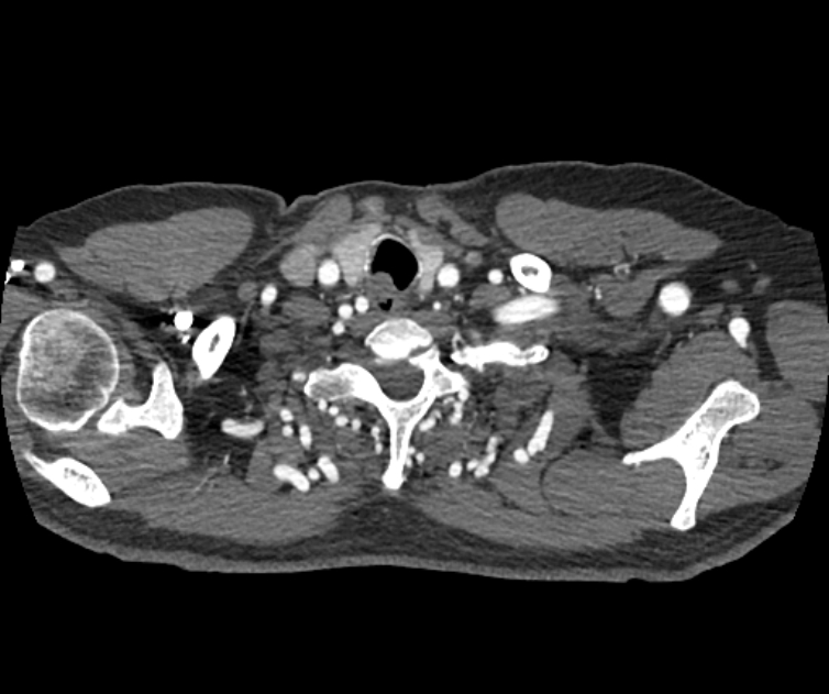 Coarctation of the aorta (Radiopaedia 53752-59822 A 14).jpg