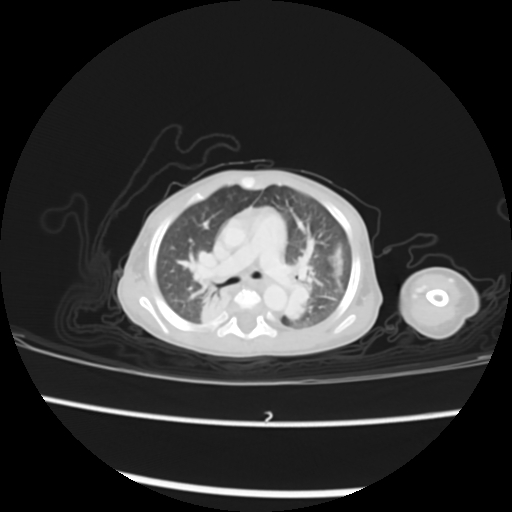 Coarctation of the aorta and patent ductus arteriosus (Radiopaedia 68033-77499 Axial lung window 20).jpg