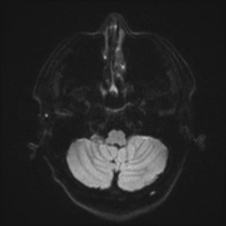 Cochlear incomplete partition type III associated with hypothalamic hamartoma (Radiopaedia 88756-105498 Axial DWI 47).jpg