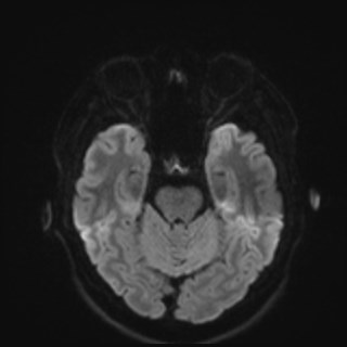 File:Cochlear incomplete partition type III associated with hypothalamic hamartoma (Radiopaedia 88756-105498 Axial DWI 54).jpg
