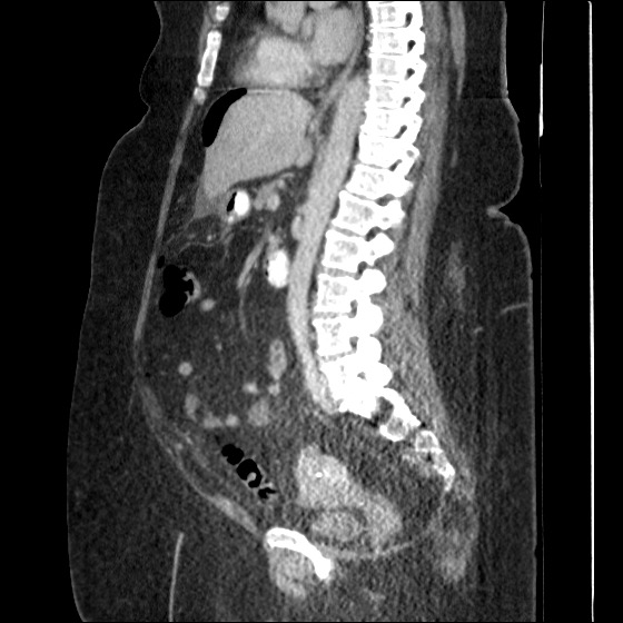 File:Collection due to leak after sleeve gastrectomy (Radiopaedia 55504-61972 C 34).jpg