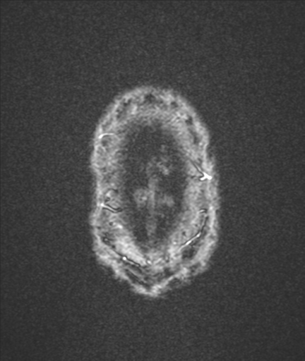 File:Colloid cyst (Radiopaedia 44510-48181 Axial Gradient Echo 26).png