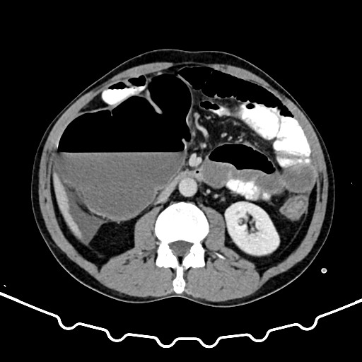 File:Colocolic intussusception due to large lipoma (Radiopaedia 68773-78482 A 86).jpg