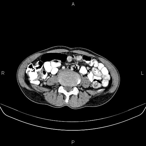 File:Colon adenocarcinoma - hepatic flexure (Radiopaedia 85635-101395 A 56).jpg