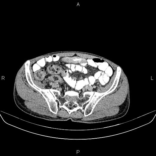 File:Colon adenocarcinoma - hepatic flexure (Radiopaedia 85635-101395 Axial C+ delayed 73).jpg