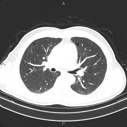 File:Colon cancer (Radiopaedia 85663-101443 Axial lung window 29).jpg