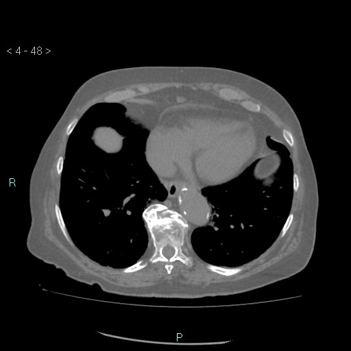 File:Colonic lipomas (Radiopaedia 49137-54244 Axial bone window 22).jpg