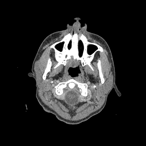 File:Nasal pyogenic granuloma (lobular capillary hemangioma) (Radiopaedia 85536-101244 C 7).jpg