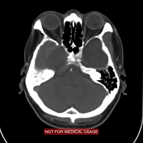 File:Nasopharyngeal carcinoma recurrence - skull base destruction (Radiopaedia 29107-29491 A 4).jpg