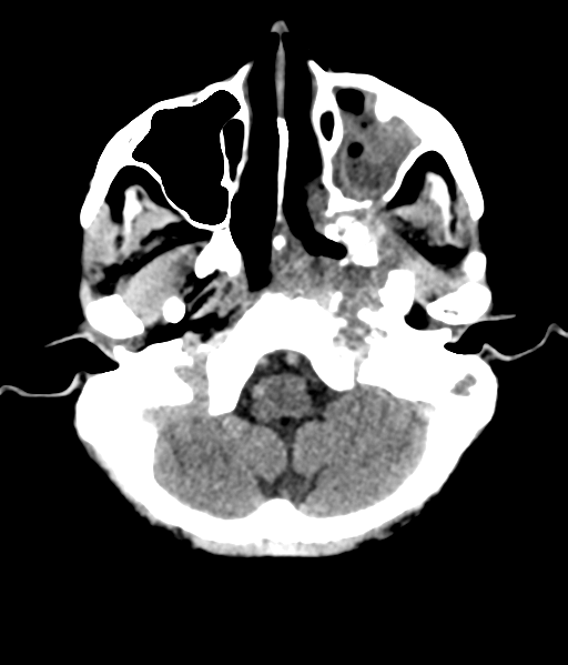 File:Nasopharyngeal carcinoma with cerebral abscess (Radiopaedia 43018-46275 Axial non-contrast 11).png
