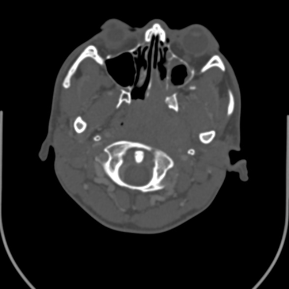 Nasopharyngeal carcinoma with skull base invasion (Radiopaedia 53415-59705 Axial bone window 40).jpg