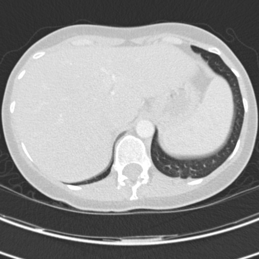 File:Necrobiotic pulmonary nodules - Crohn disease (Radiopaedia 20723-20631 Axial lung window 130).jpg