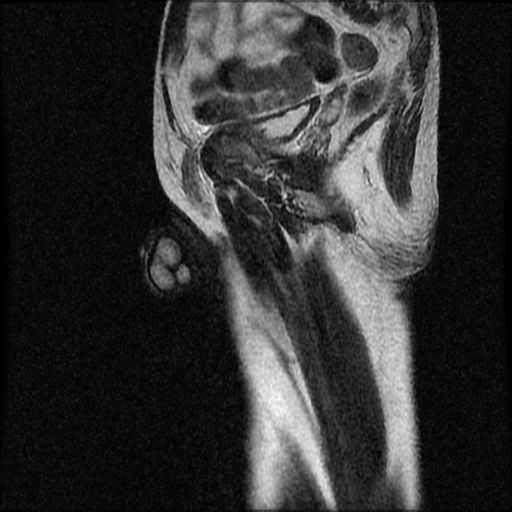 File:Necrotizing epididymo-orchitis with intra-testicular abscess (Radiopaedia 29397-29860 Sagittal T2 6).jpg