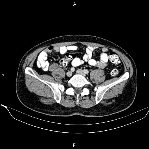 Necrotizing pancreatitis (Radiopaedia 87796-104249 A 40).jpg